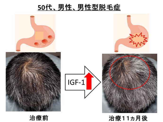 円形脱毛症　病院